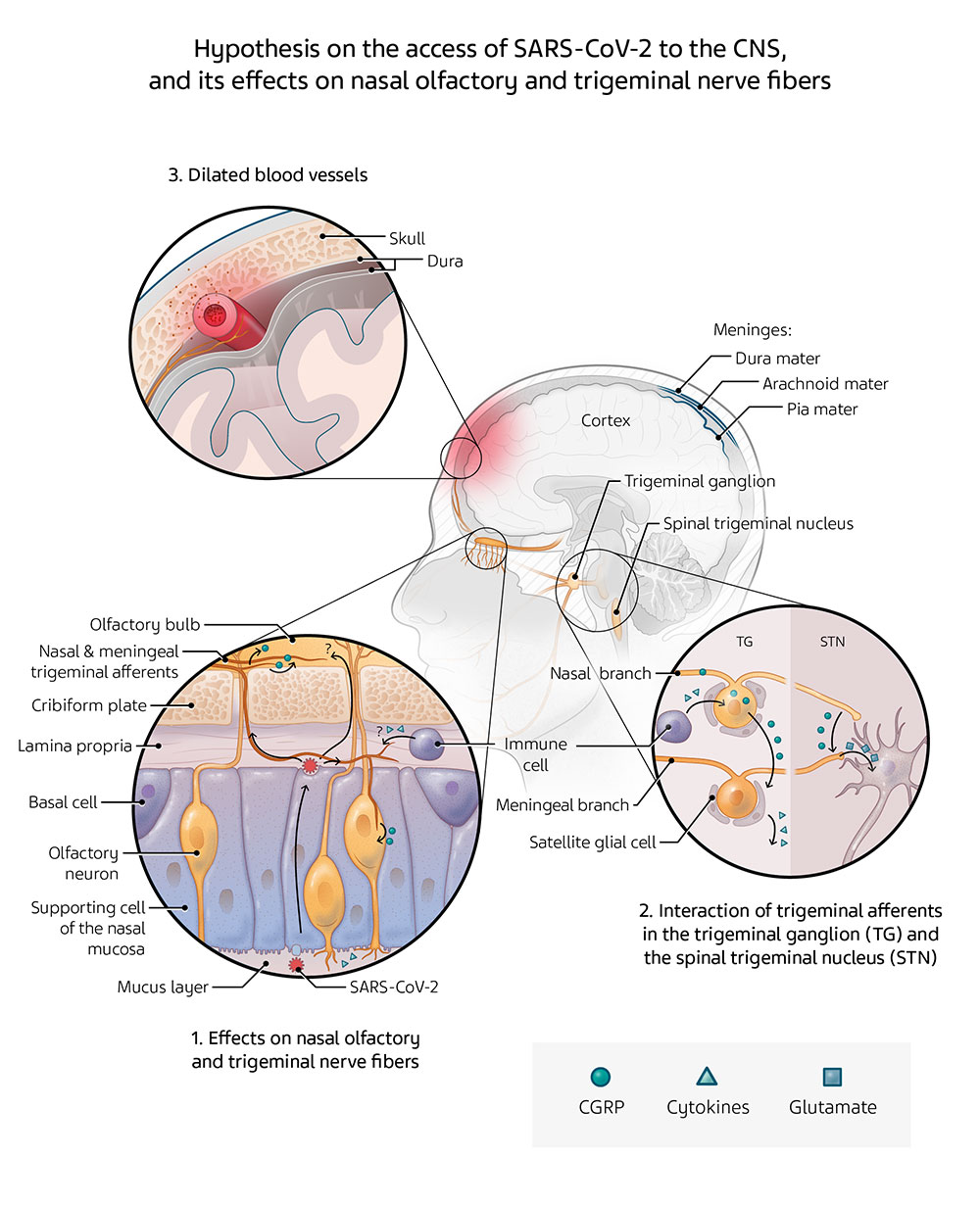 Schematic illustration of the head showing the putative pathophysiological mechanisms underlying headache associated with COVID-19.